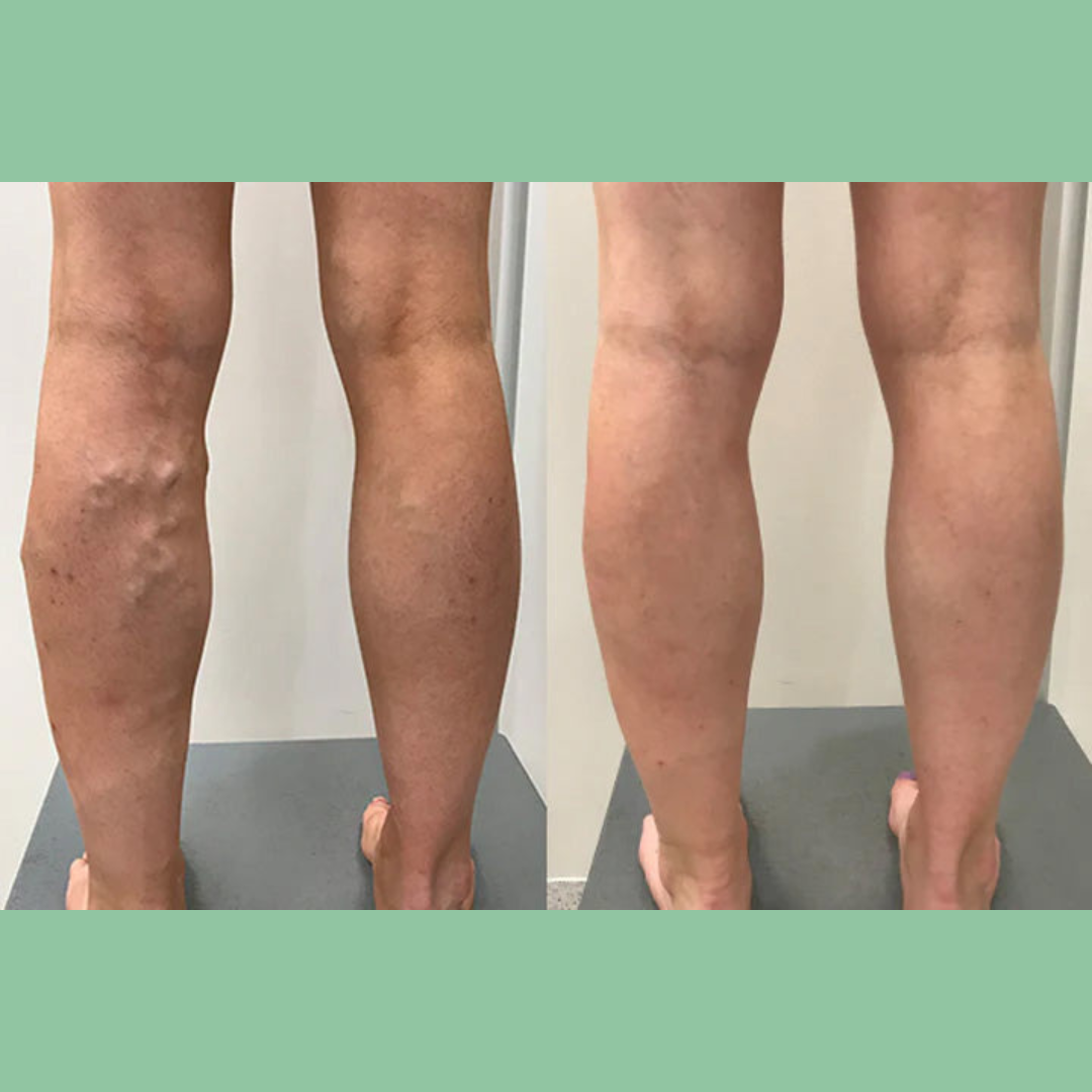 Lymphora™ – Naturlig lindring af hævelser
