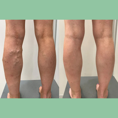 Lymphora™ – Naturlig lindring af hævelser