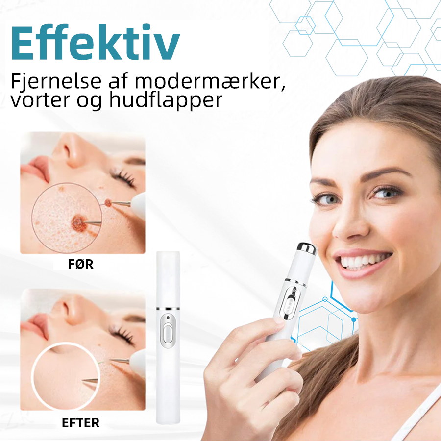 Dermaze™ – Ikke-invasiv laser fjernelse af modermærker