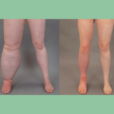 Lymphora™ – Naturlig lindring af hævelser