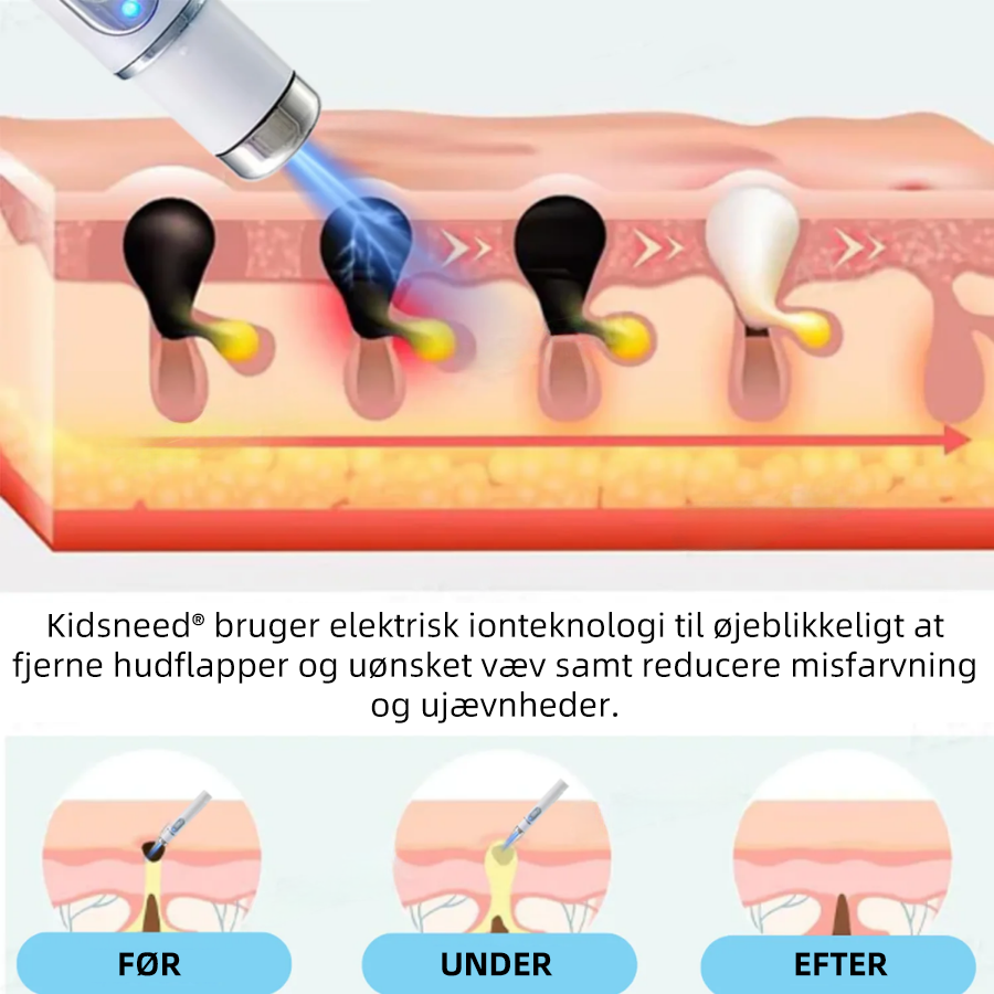Dermaze™ – Ikke-invasiv laser fjernelse af modermærker