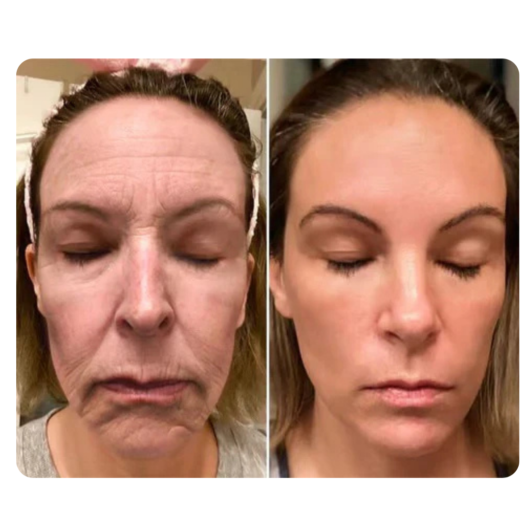 DermaLift™ – Avanceret Botox-Lignende Creme