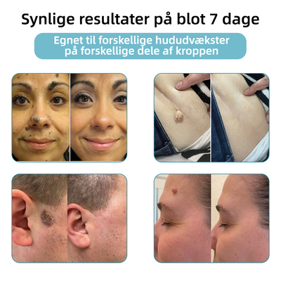 Dermaze™ – Ikke-invasiv laser fjernelse af modermærker