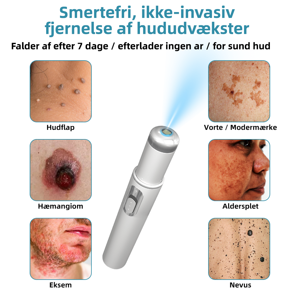 Dermaze™ – Ikke-invasiv laser fjernelse af modermærker