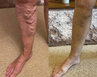 Varicell™ – Revolutionerende Varicose Vein Lindring