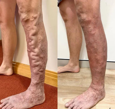 Varicell™ – Revolutionerende Varicose Vein Lindring