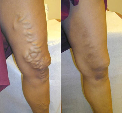 Varicell™ – Revolutionerende Varicose Vein Lindring