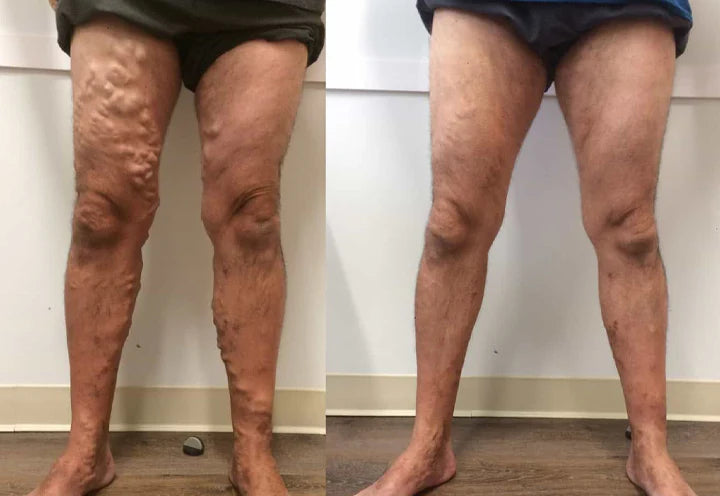 Varicell™ – Revolutionerende Varicose Vein Lindring