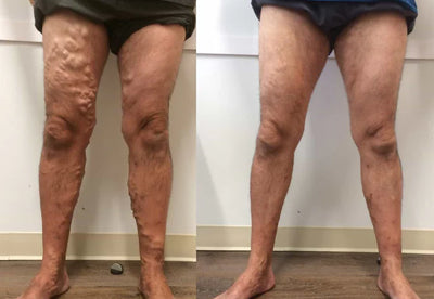 Varicell™ – Revolutionerende Varicose Vein Lindring