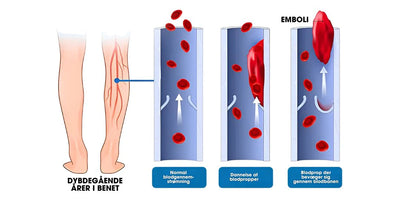 Varicell™ – Revolutionerende Varicose Vein Lindring