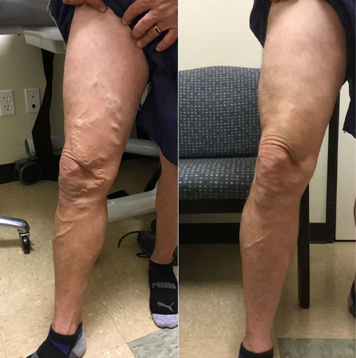 Varicell™ – Revolutionerende Varicose Vein Lindring