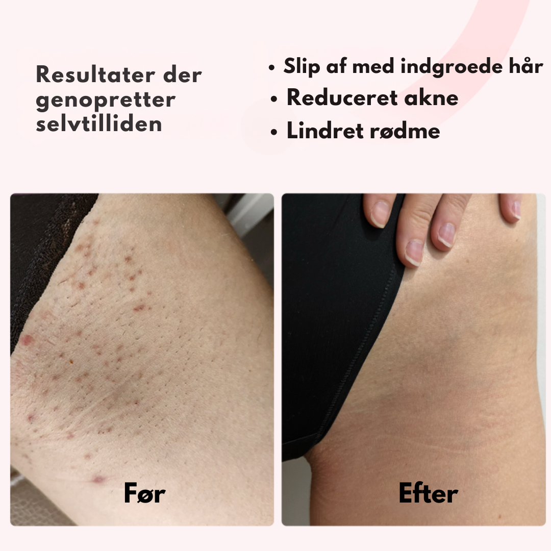 Silkify™ – Smertefri Permanent Hårfjerning