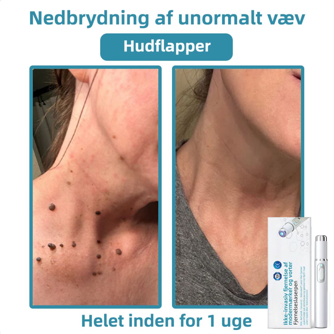 Dermaze™ – Ikke-invasiv laser fjernelse af modermærker