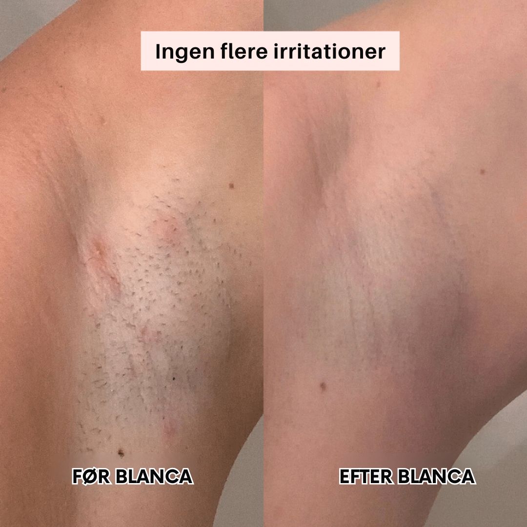 Blanca™ – Dobbelthovedet Præcisionsbarbering
