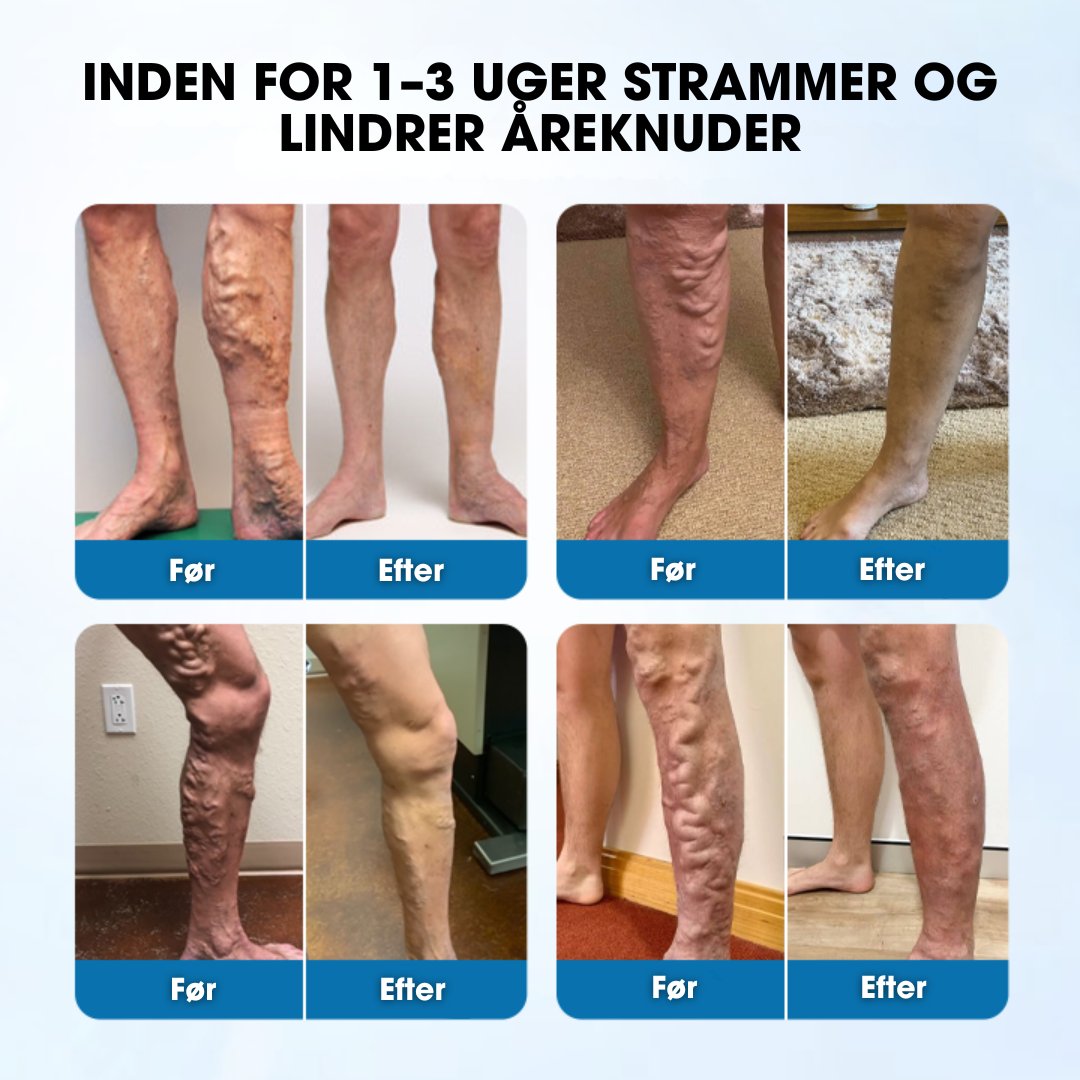 Varicell™ – Revolutionerende Varicose Vein Lindring