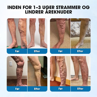 Varicell™ – Revolutionerende Varicose Vein Lindring