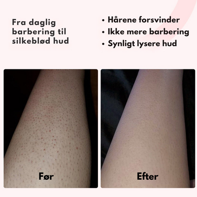 Silkify™ – Smertefri Permanent Hårfjerning