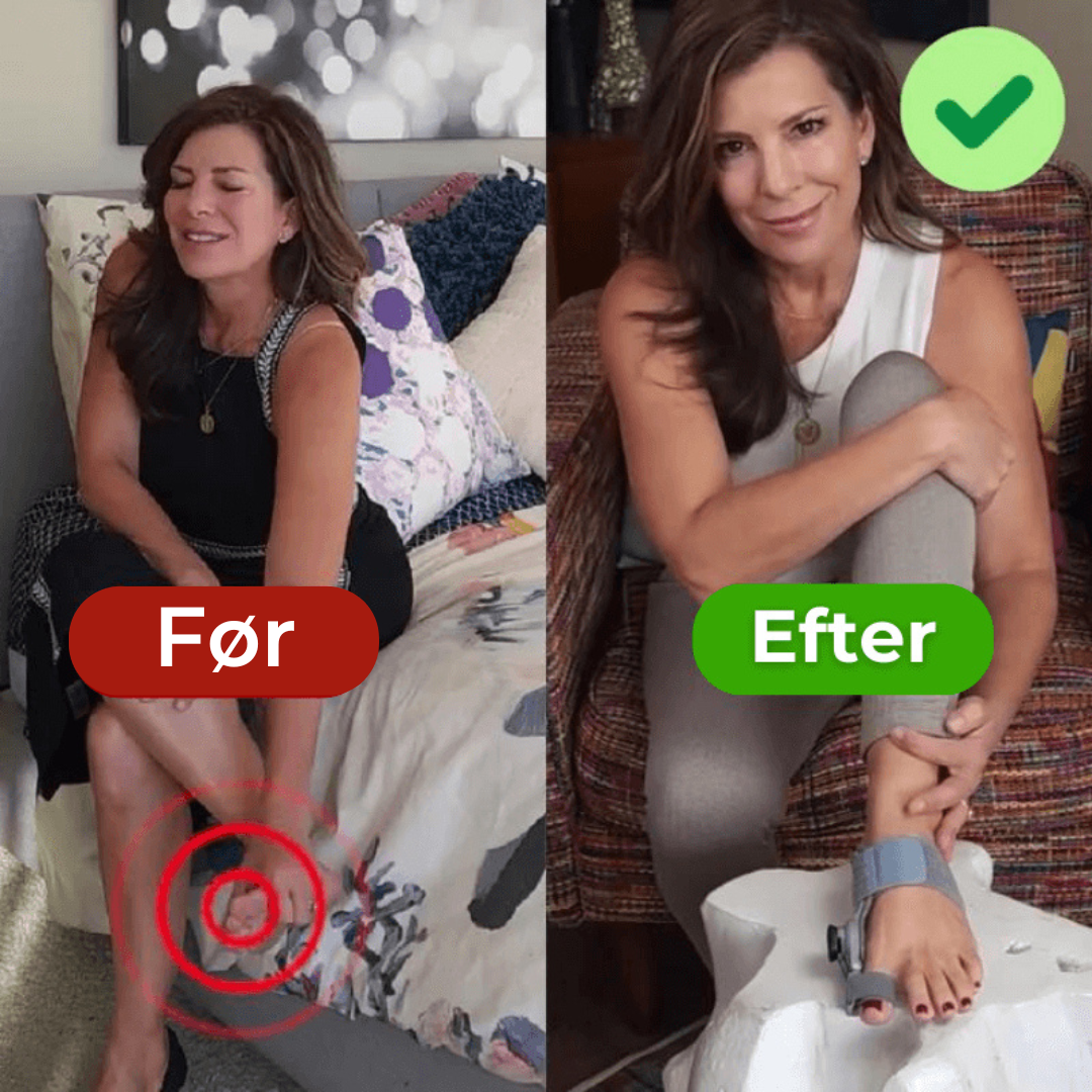 ToeComfort™ – Smertelindring og Korrektur for Hallux Valgus