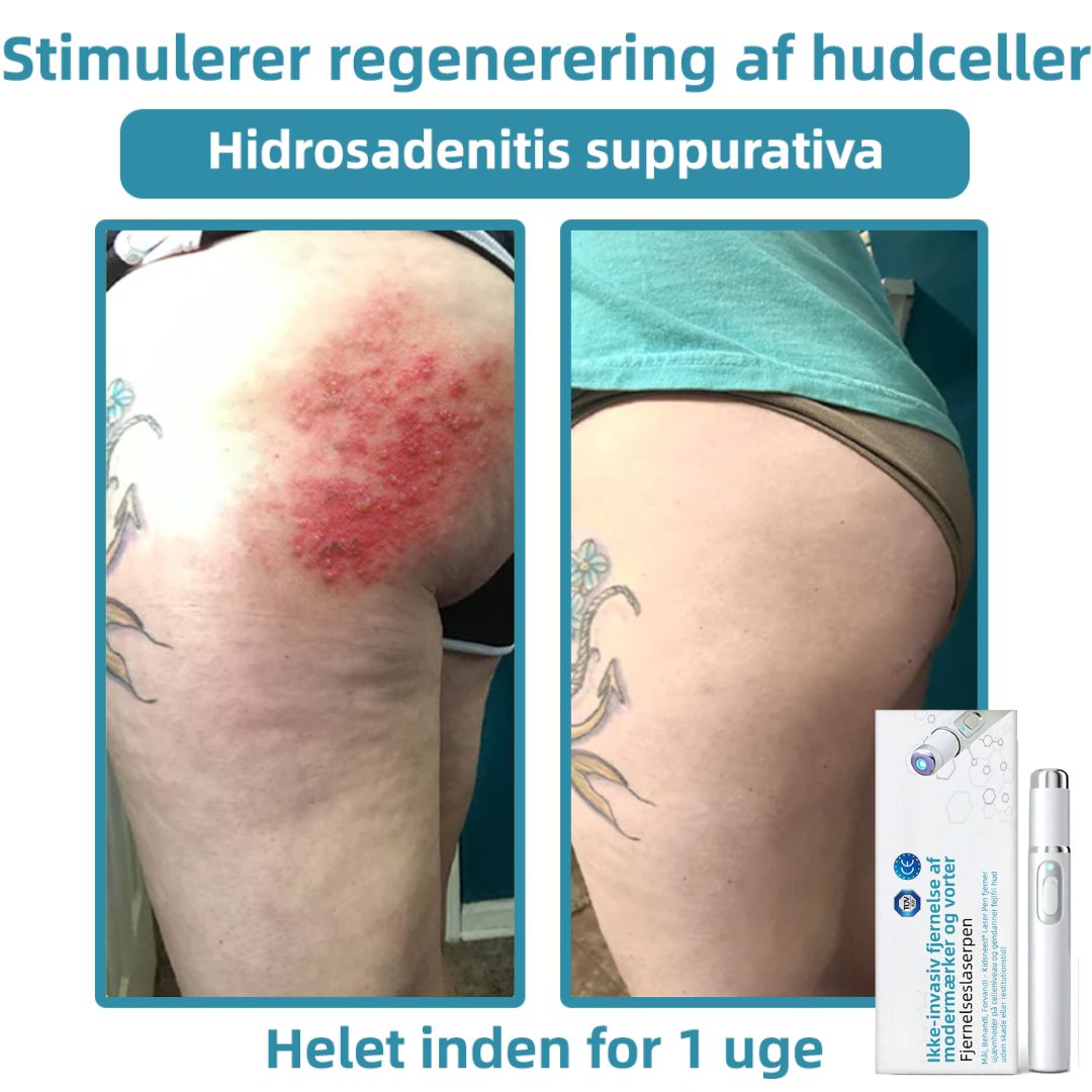 Dermaze™ – Ikke-invasiv laser fjernelse af modermærker