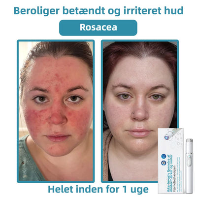 Dermaze™ – Ikke-invasiv laser fjernelse af modermærker