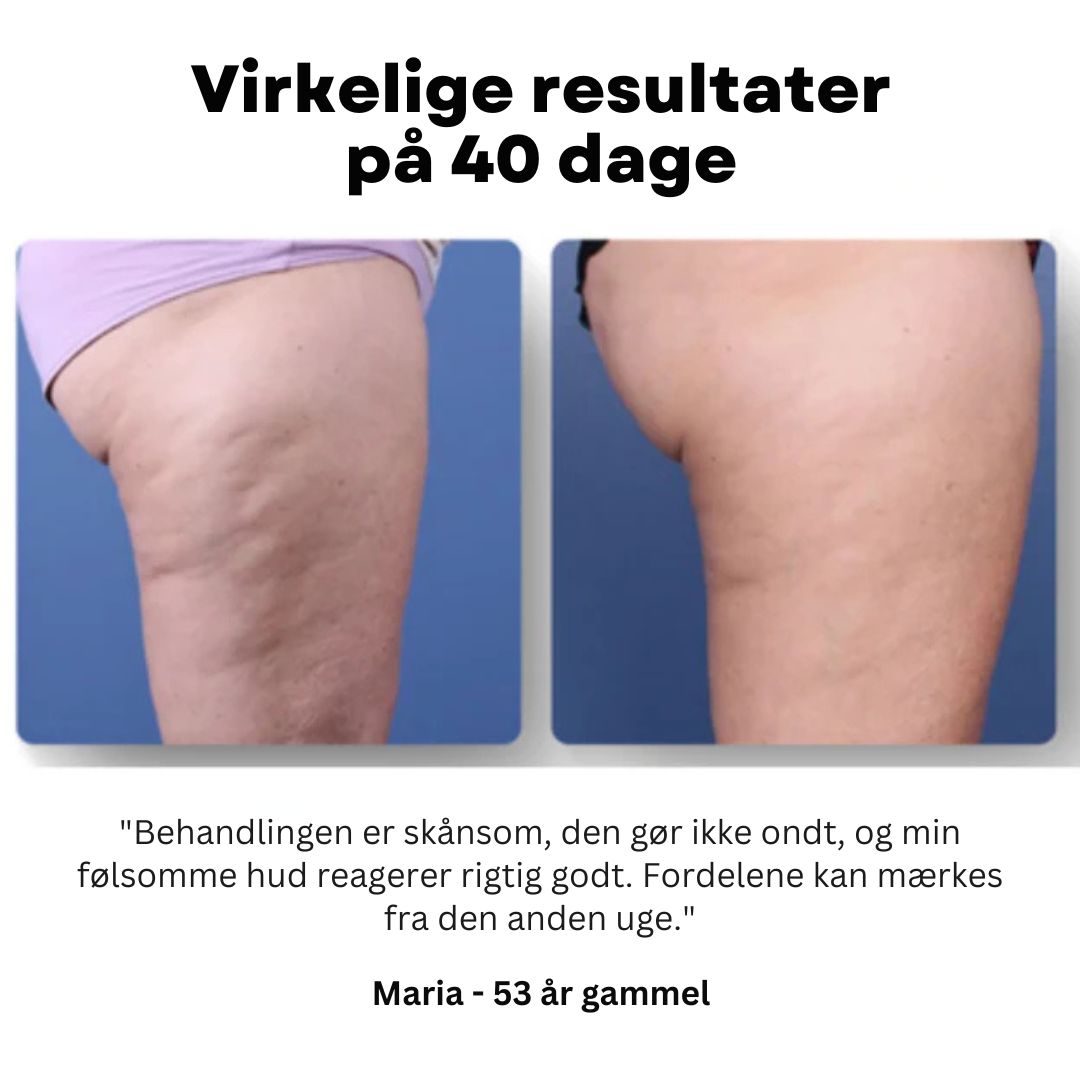 Cellexa™ - Cellulite Reduceringsmassager