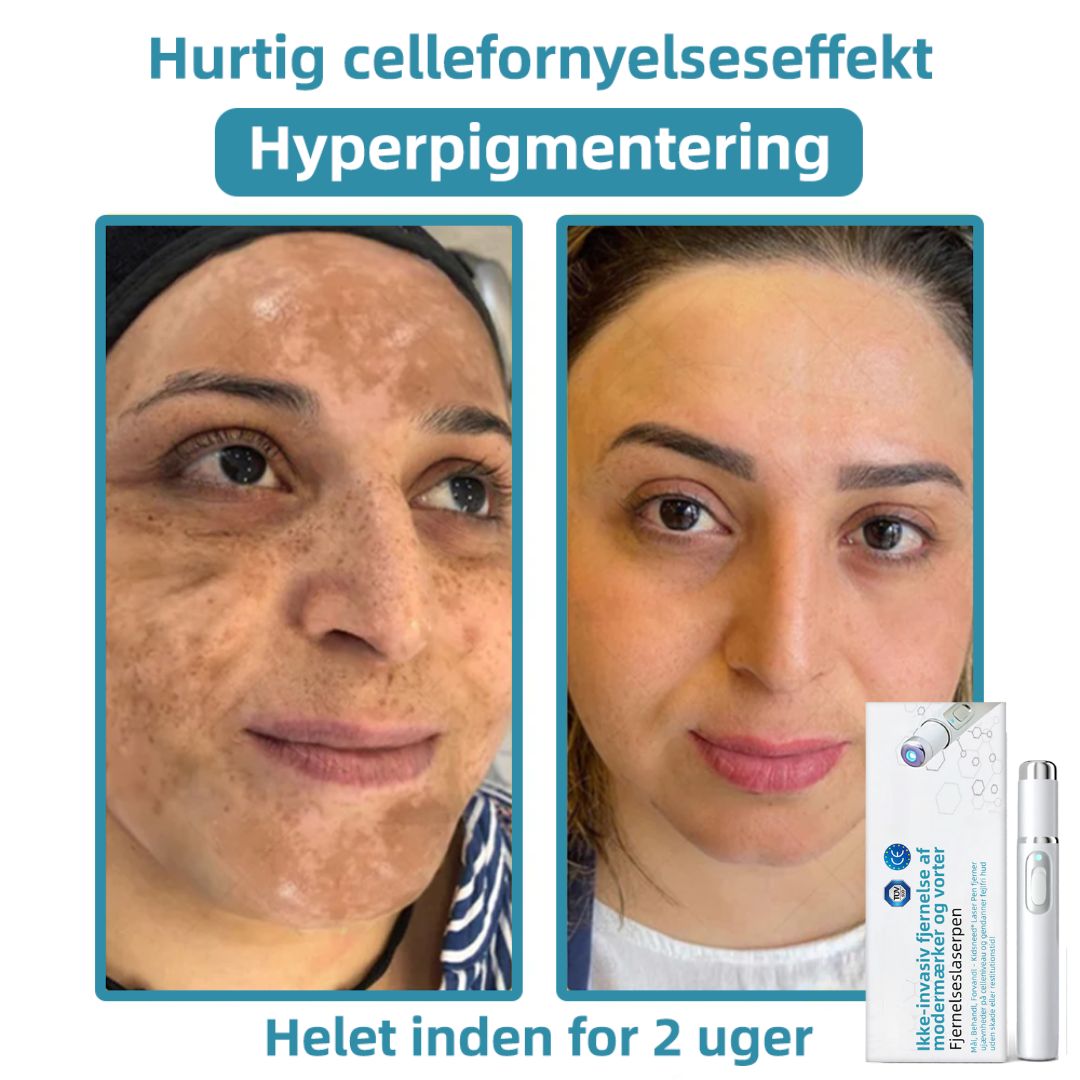 Dermaze™ – Ikke-invasiv laser fjernelse af modermærker