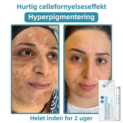 Dermaze™ – Ikke-invasiv laser fjernelse af modermærker
