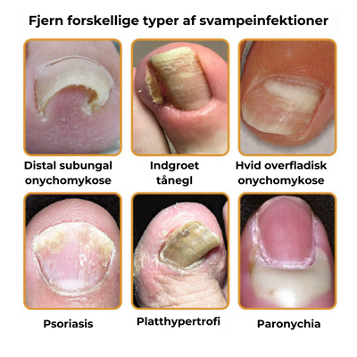 NailVive™ – Neglesvamp Behandlingsserum