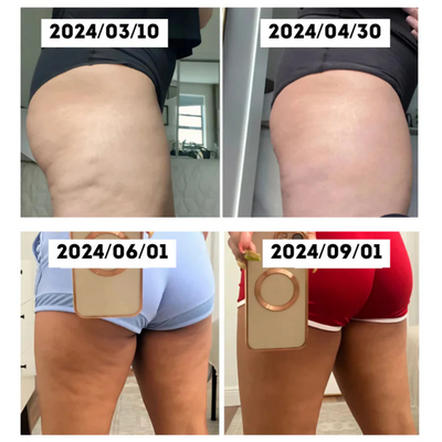 Sculptelle™ – Avanceret 4-i-1 Anti-Cellulite Massageapparat