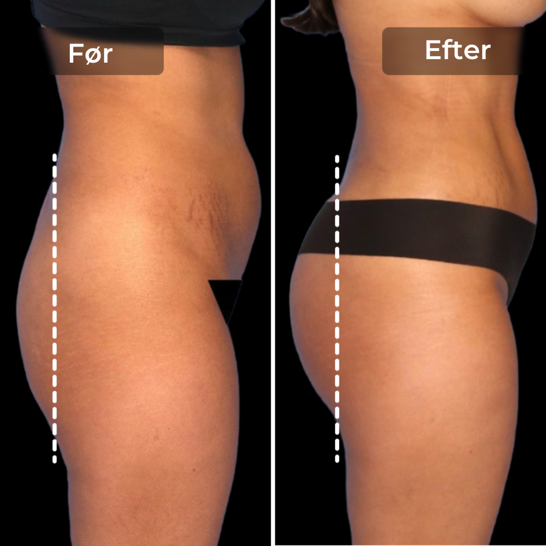CoreLift™ – EMS-Shorts til Formning Og Toning