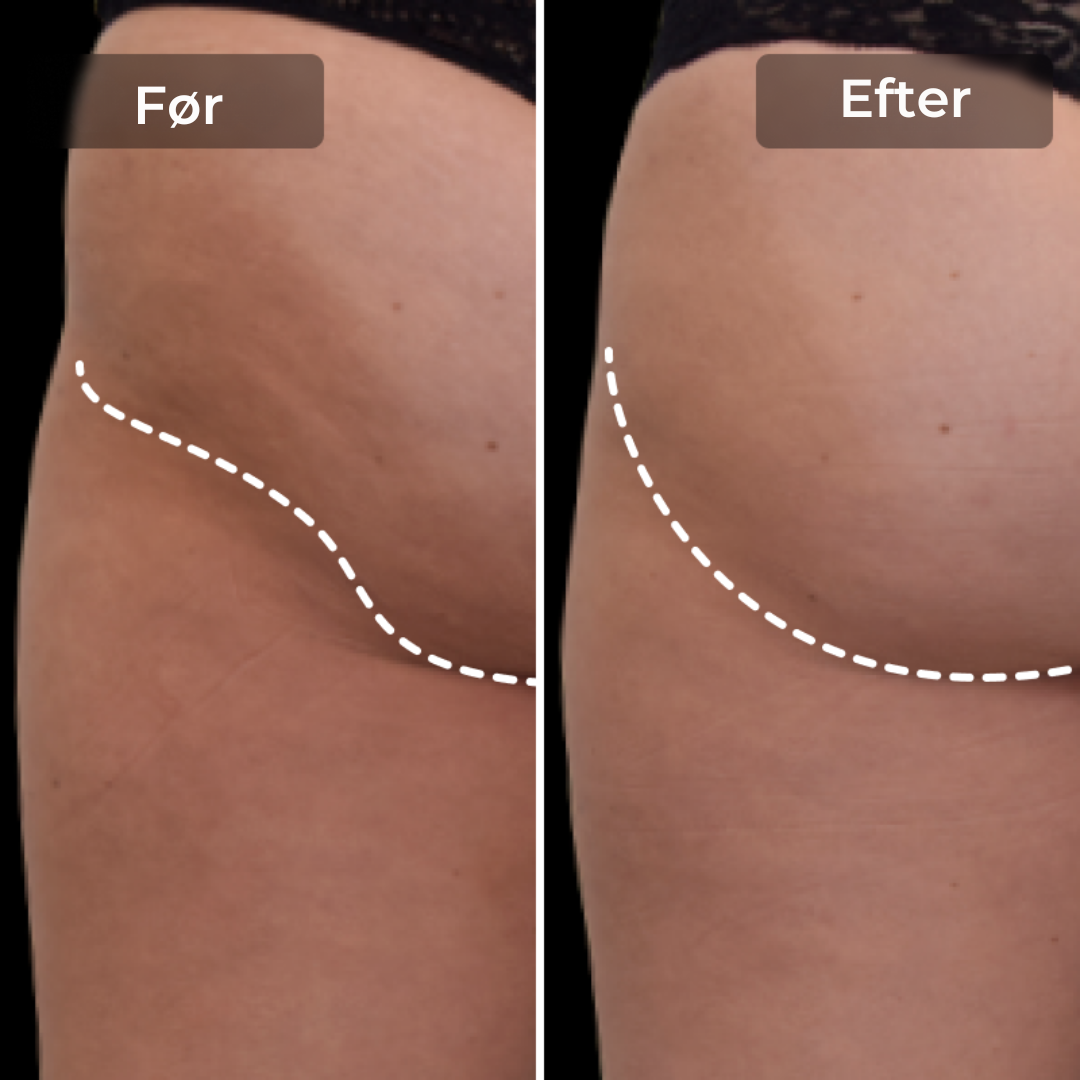 CoreLift™ – EMS-Shorts til Formning Og Toning