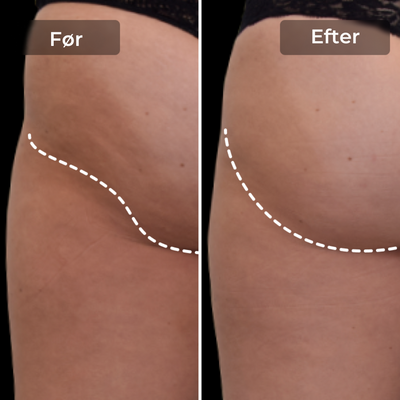 CoreLift™ – EMS-Shorts til Formning Og Toning