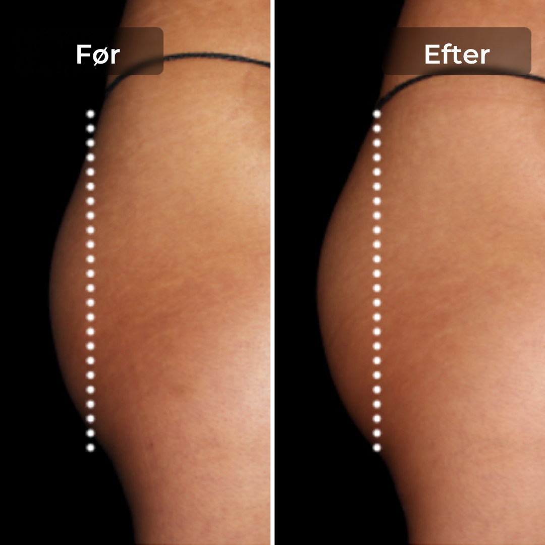 CoreLift™ – EMS-Shorts til Formning Og Toning