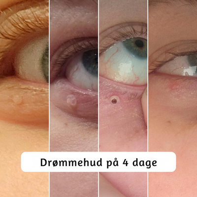 DermaLoop™ – Smertefri Fjernelse af Hudmærker