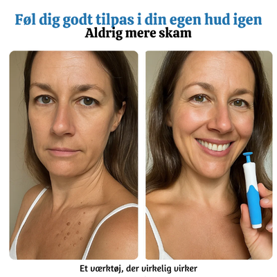 DermaLoop™ – Smertefri Fjernelse af Hudmærker