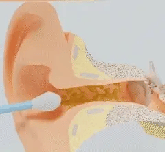 EarClear™ - Smart Øronrens