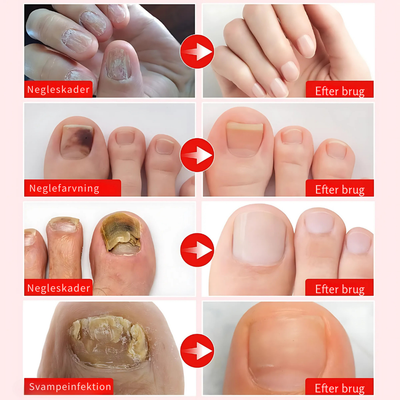 Nailfix™ – Ekstra Stærk Neglereparationsløsning
