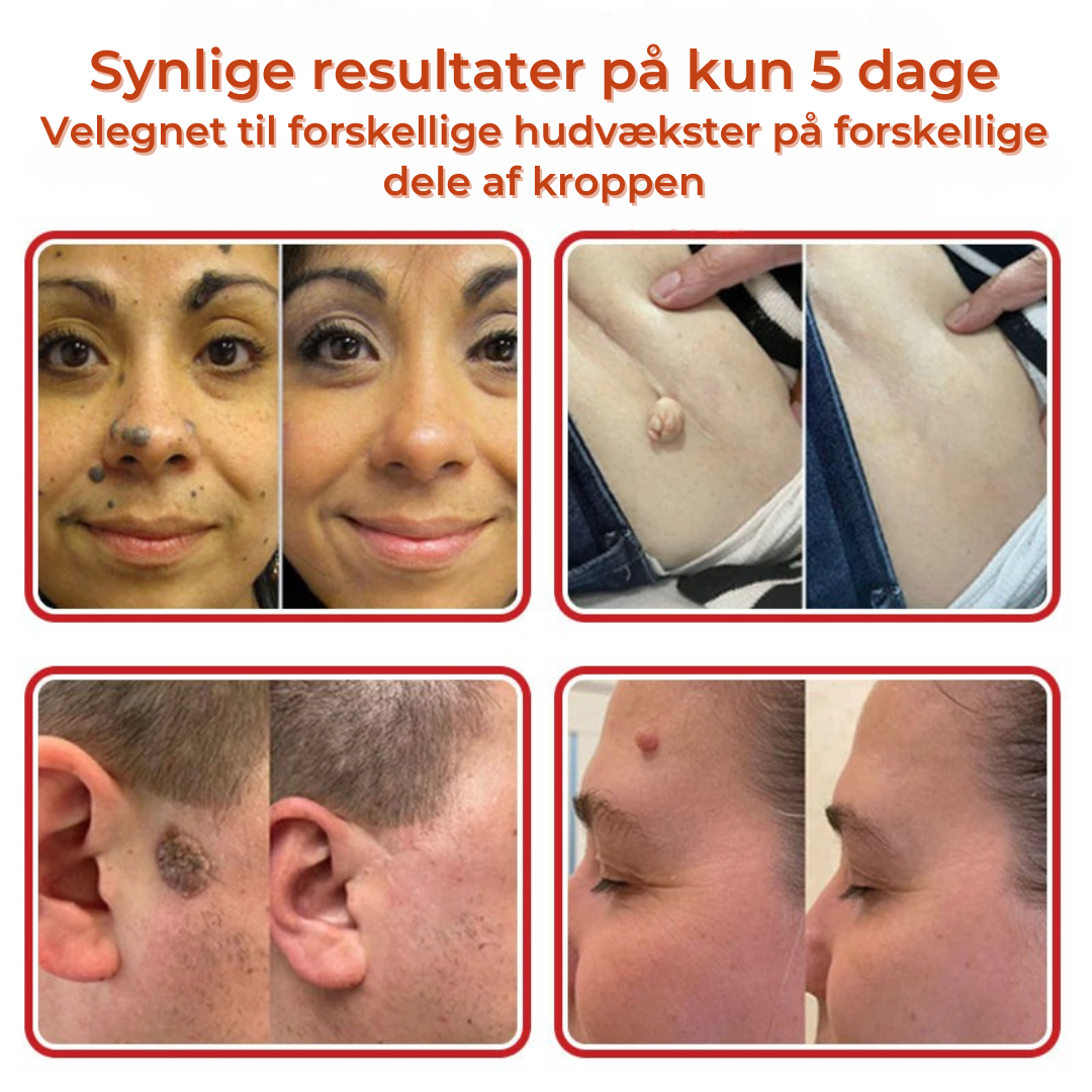 SkinLift™ – Botanisk Hudmærkefjerner