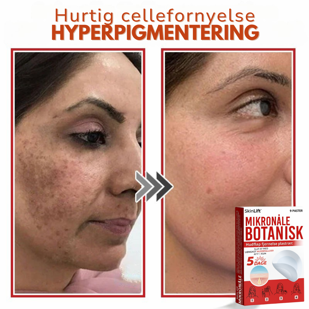 SkinLift™ – Botanisk Hudmærkefjerner