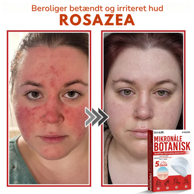 SkinLift™ – Botanisk Hudmærkefjerner