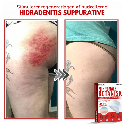 SkinLift™ – Botanisk Hudmærkefjerner
