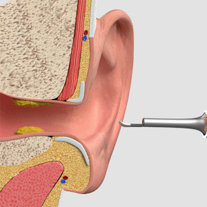 EarClear™ - Smart Øronrens
